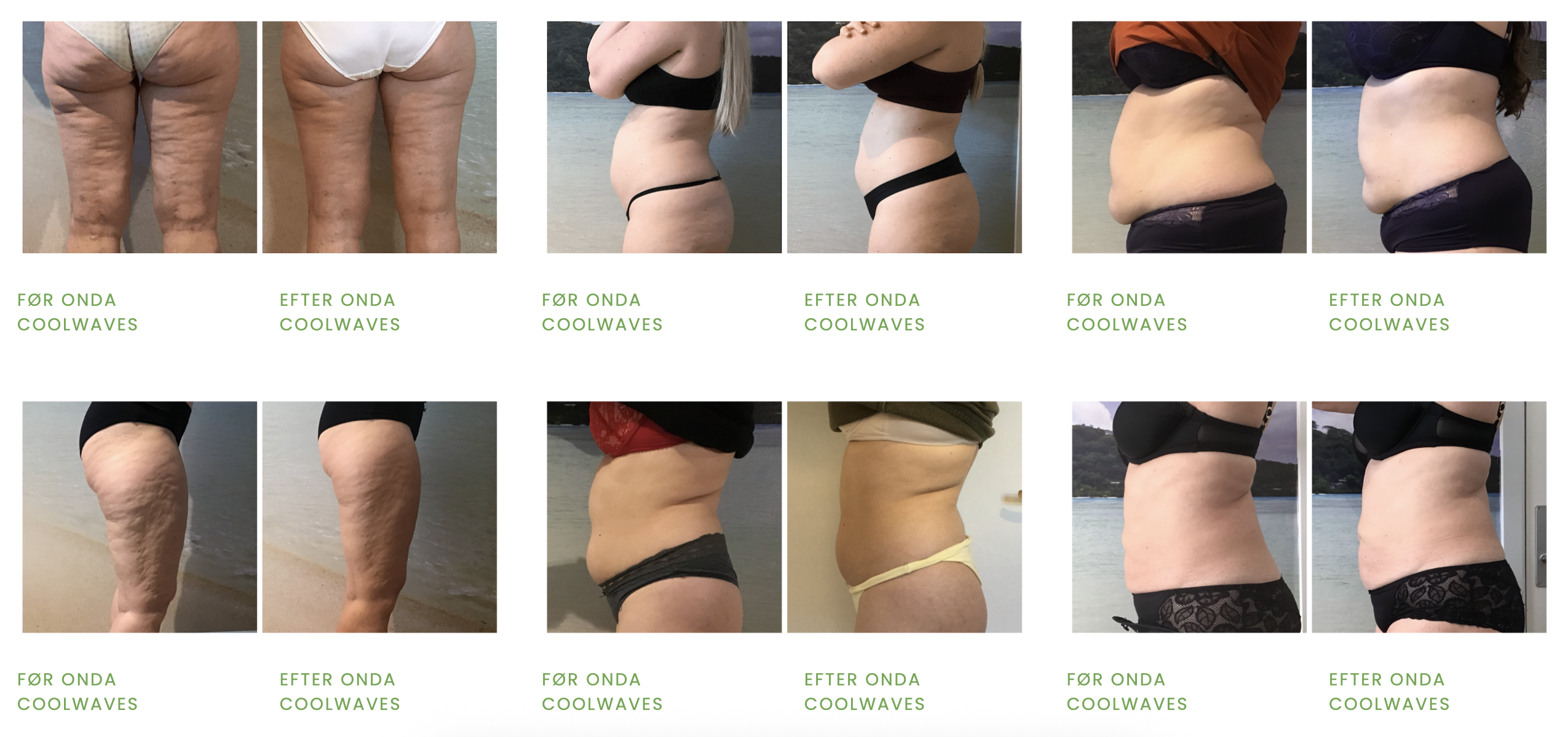 ONDA Før Og Efter Hos Bodycool